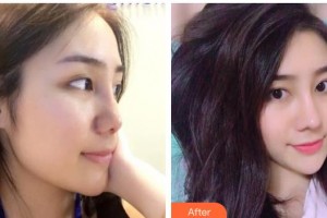 陜西省人民醫(yī)院燒傷整形醫(yī)學(xué)美容科孫要文整形價格表附鼻部綜合案例展示