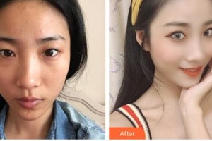 陜西同濟醫(yī)院激光美容中心武媚整形價格表附眼部綜合案例展示