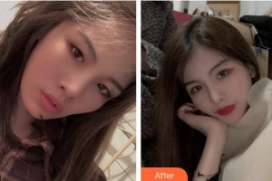 陜西華西醫(yī)院西美整形美容中心何旭整形價格表附眼部綜合案例展示