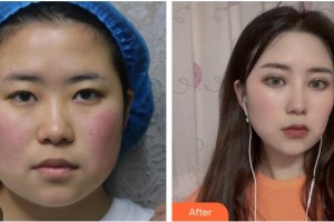 銅川礦務局中心醫(yī)院燒傷整形科成茂江整形價格表附眼部綜合案例展示