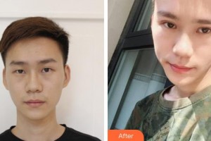 銅川礦務局中心醫(yī)院燒傷整形科王建軍整形價格表附切開雙眼皮案例展示