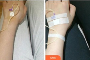 寶雞中心醫(yī)院燒傷整形科習耀峰整形價格表附美白導入案例展示