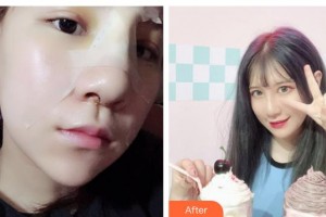 寶雞人民醫(yī)院整形美容科張林宏整形價格表附清潔祛痘案例展示