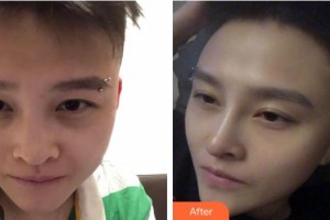 寶雞高新人民醫(yī)院整形美容外科岳能武整形價格表附紅藍光祛痘案例展示