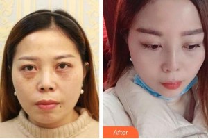 寶雞高一生醫(yī)療美容門醫(yī)院楊善整形價格表附眼部綜合案例展示