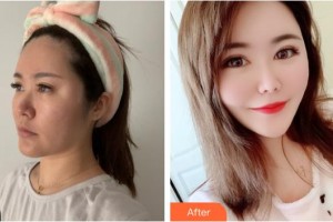 寶雞愛爾眼科醫(yī)院楚征宇整形價格表附牙齒陶瓷矯正案例展示