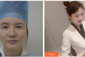 寶雞高一生醫(yī)療美容門醫(yī)院張進南整形價格表附上眼瞼去脂案例展示