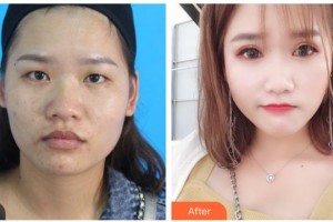 寶雞愛爾眼科醫(yī)院李康寯整形價格表附切開雙眼皮案例展示