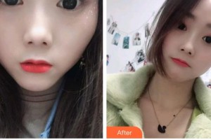 寶雞愛爾眼科醫(yī)院徐慶齋整形價格表附切開雙眼皮案例展示