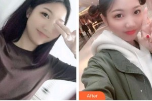 寶雞市口腔醫(yī)院湯臘梅整形價格表附根管調(diào)節(jié)案例展示