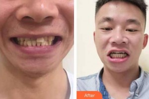 寶雞市口腔醫(yī)院馮耀浦整形價格表附牙齒隱形矯正案例展示