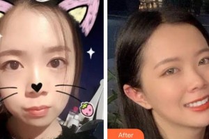 寶雞市口腔醫(yī)院董海文整形價格表附金屬托槽矯正案例展示