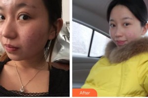 常熟瑞麗美貝爾美容醫(yī)院魯勝霞整形價(jià)格表附光子嫩膚案例展示