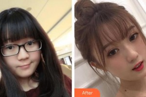 常熟市第一人民醫(yī)院燒傷整形科張琦整形價(jià)格表附切開雙眼皮案例展示