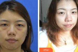 常熟市第五人民醫(yī)院皮膚醫(yī)學(xué)美容中心王雪松整形價(jià)格表附激光去眼袋案例展示