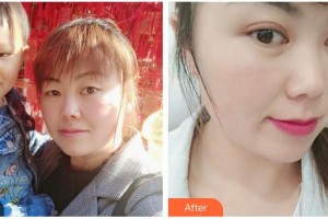 常熟市第二人民醫(yī)院眼科莊建青整形價(jià)格表附切開雙眼皮案例展示