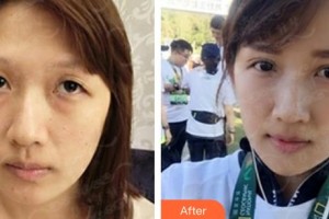 常熟市第二人民醫(yī)院眼科徐明整形價(jià)格表附埋線雙眼皮案例展示