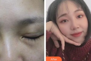 常熟市第二人民醫(yī)院眼科秦燕整形價(jià)格表附眼部修復(fù)案例展示