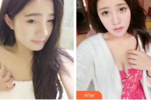 常熟市第二人民醫(yī)院眼科陳海英整形價(jià)格表附切開雙眼皮案例展示