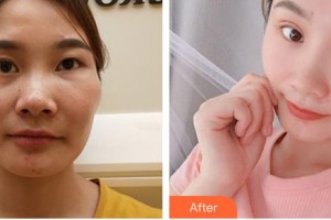 常熟市第二人民醫(yī)院眼科王瑾瑜整形價(jià)格表附切開雙眼皮案例展示