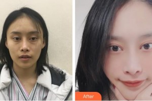 常熟市第二人民醫(yī)院眼科李函整形價(jià)格表附內(nèi)切祛眼袋案例展示