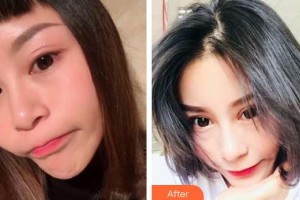 常熟廣仁醫(yī)院眼科劉新泉整形價(jià)格表附切開雙眼皮案例展示