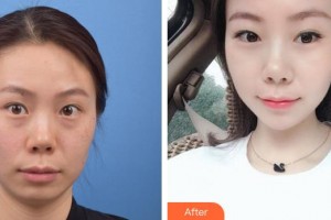 貴州整形美容外科醫(yī)院梁安裕整形價格表附激光祛斑案例展示