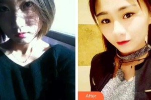 貴州整形美容外科醫(yī)院劉磊整形價格表附激光祛斑案例展示