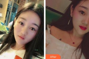 貴州省人民醫(yī)院整形美容燒傷顯微外科郭曉波整形價格表附微針水光案例展示