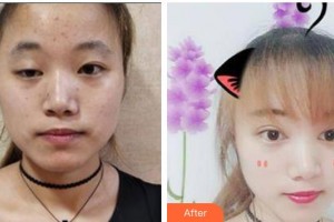 貴州醫(yī)科大學第二附屬醫(yī)院醫(yī)學美容整形外科彭洲整形價格表附彩光嫩膚案例展示