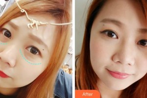 貴州晶朗眼科醫(yī)院喬薇整形價格表附眶隔脂肪釋放案例展示