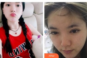 貴州晶朗眼科醫(yī)院劉媛整形價格表附眼部綜合案例展示