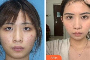 貴州晶朗眼科醫(yī)院楊安昌整形價(jià)格表附眼部綜合案例展示