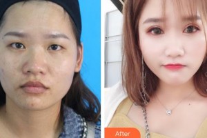 貴州整形美容外科醫(yī)院席小紅整形價(jià)格表附切開(kāi)雙眼皮案例展示