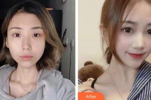 貴州普瑞眼科醫(yī)院李志敏整形價(jià)格表附眼部綜合案例展示