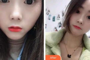 貴陽(yáng)愛(ài)爾眼科醫(yī)院陳曉鐘整形價(jià)格表附切開(kāi)雙眼皮案例展示