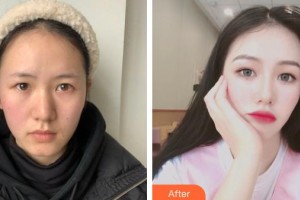 貴陽(yáng)愛(ài)爾眼科醫(yī)院孫儀亞整形價(jià)格表附眼部綜合案例展示