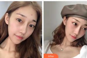 貴陽(yáng)愛(ài)爾眼科醫(yī)院胡大立整形價(jià)格表附眼部綜合案例展示