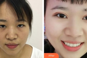 貴陽(yáng)愛(ài)爾眼科醫(yī)院陳國(guó)榮整形價(jià)格表附定點(diǎn)雙眼皮案例展示