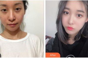 貴陽(yáng)愛(ài)爾眼科醫(yī)院廖進(jìn)軍整形價(jià)格表附切開(kāi)雙眼皮案例展示