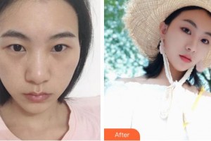 貴陽(yáng)愛(ài)爾眼科醫(yī)院鐘燕整形價(jià)格表附眼部綜合案例展示