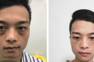 貴陽(yáng)愛(ài)爾眼科醫(yī)院黃加兵整形價(jià)格表附激光去眼袋案例展示