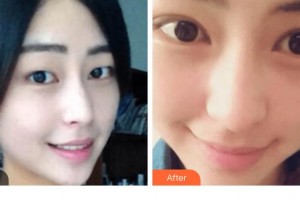 貴陽(yáng)愛(ài)爾眼科醫(yī)院陳曉玲整形價(jià)格表附切開(kāi)雙眼皮案例展示