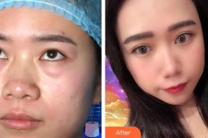 貴陽(yáng)愛(ài)爾眼科醫(yī)院王文放整形價(jià)格表附內(nèi)切祛眼袋案例展示