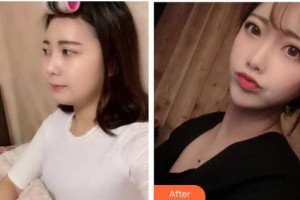 貴陽(yáng)愛(ài)爾眼科醫(yī)院蒲麗整形價(jià)格表附眼部綜合案例展示