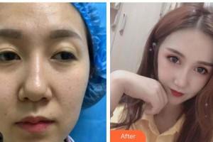 六盤(pán)水麗人醫(yī)院醫(yī)療美容科劉曉君整形價(jià)格表附眼部綜合案例展示