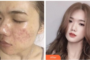 遵義利美康整形美容醫(yī)院章超整形價(jià)格表附紅藍(lán)光祛痘案例展示