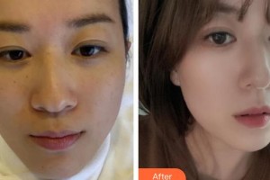 遵義利美康整形美容醫(yī)院羅曉珊高級(jí)紋繡師整形價(jià)格表附激光祛斑案例展示