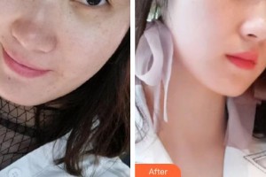 遵義利美康整形美容醫(yī)院羅美媛住院醫(yī)師整形價(jià)格表附激光祛斑案例展示