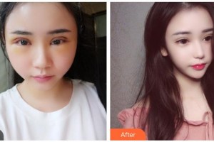 遵義韓美整形美容醫(yī)院汪玉云整形價(jià)格表附切開(kāi)雙眼皮案例展示